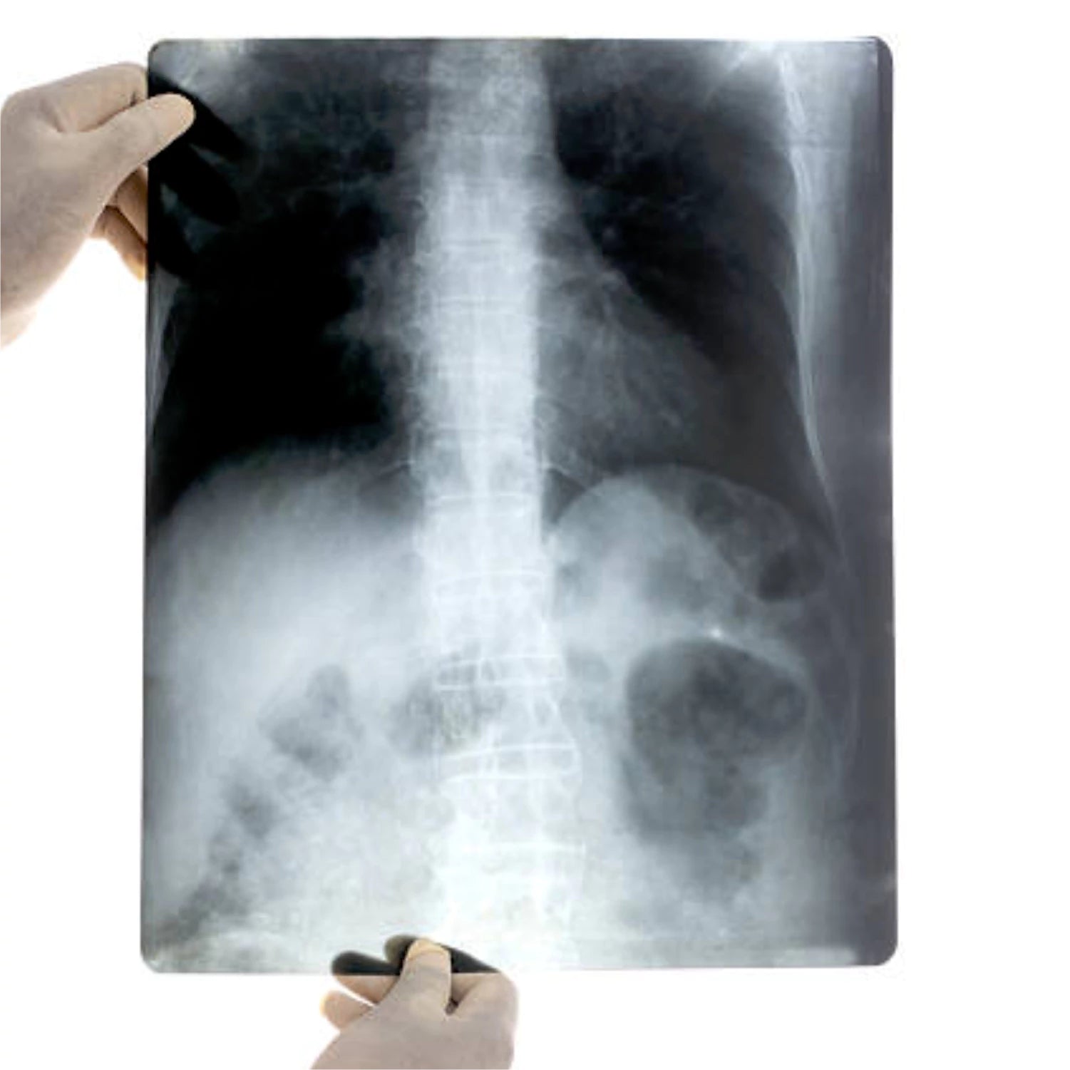 VMS Medical 10x12 X-Ray Hi-Speed Film - Blue Sensitive X-ray Front